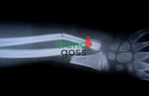 Chinese Scientists Develop Revolutionary Bone Glue That Heals Fractures In Just Minutes